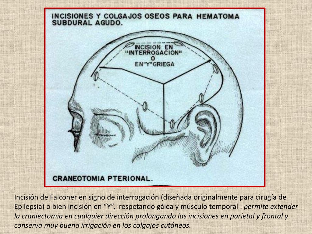 Incisión de Falconer en signo de interrogación (diseñada originalmente para cirugía de Epilepsia) o bien incisión en Y , respetando gálea y músculo temporal : permite extender la craniectomía en cualquier dirección prolongando las incisiones en parietal y frontal y conserva muy buena irrigación en los colgajos cutáneos.