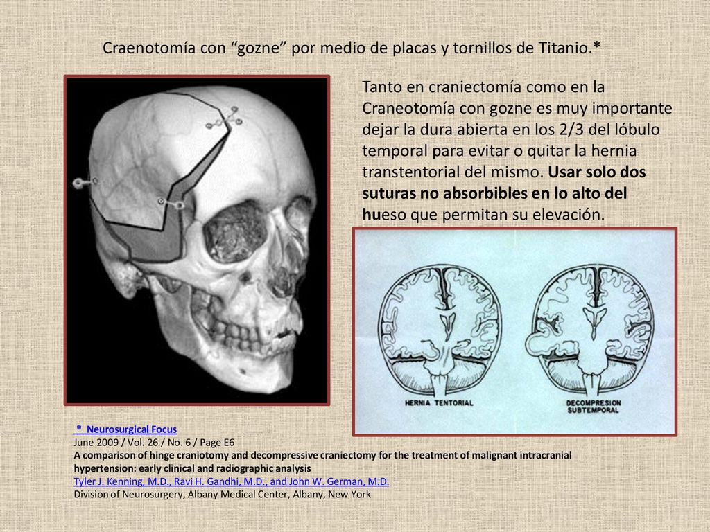 Craenotomía con gozne por medio de placas y tornillos de Titanio.*