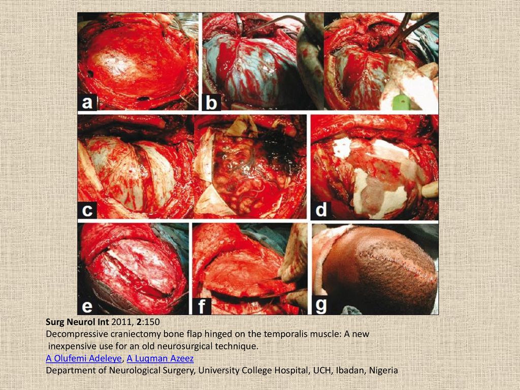 Surg Neurol Int 2011, 2:150 Decompressive craniectomy bone flap hinged on the temporalis muscle: A new.