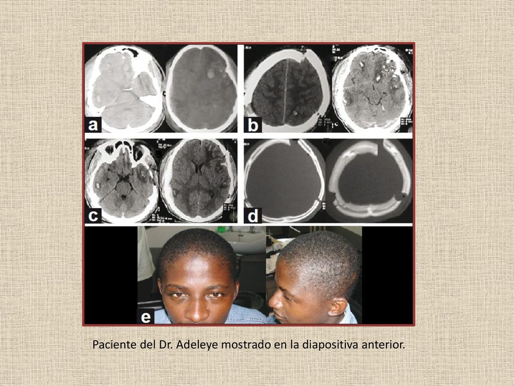 Paciente del Dr. Adeleye mostrado en la diapositiva anterior.