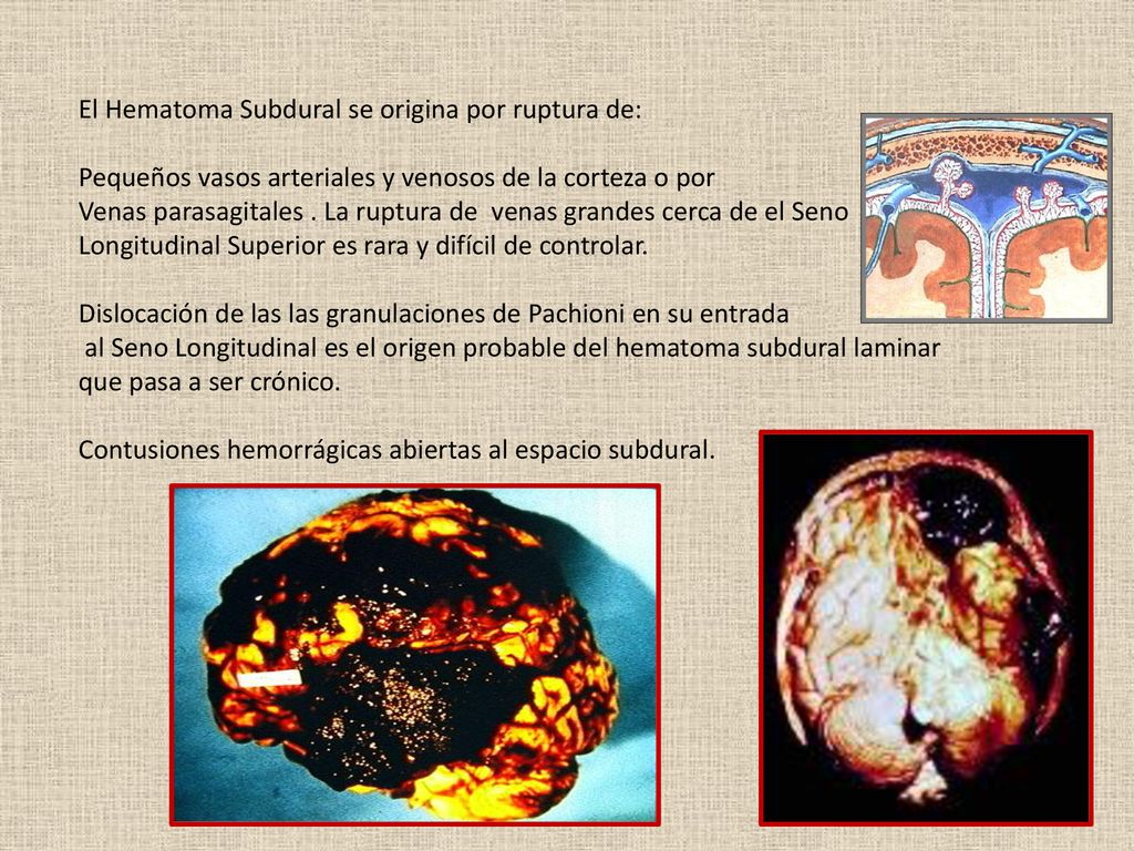 El Hematoma Subdural se origina por ruptura de: