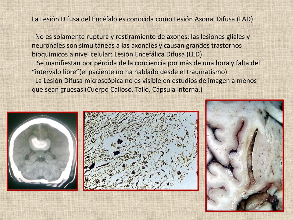 La Lesión Difusa del Encéfalo es conocida como Lesión Axonal Difusa (LAD)