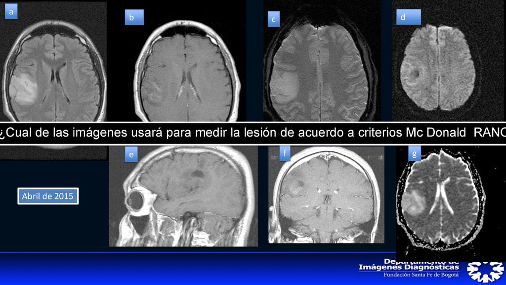 a b. c. d. ¿Cual de las imágenes usará para medir la lesión de acuerdo a criterios Mc Donald RANO.