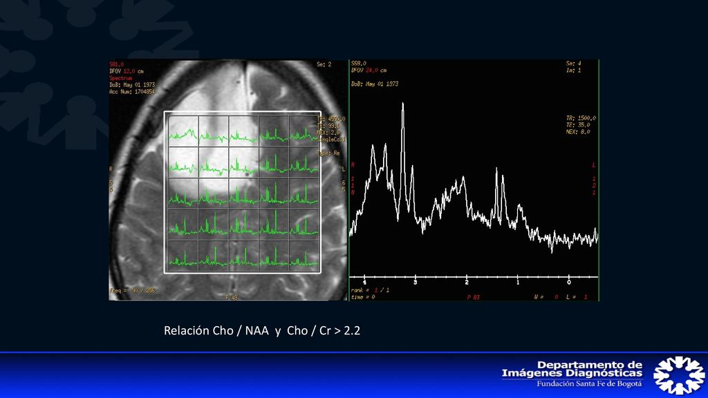 Relación Cho / NAA y Cho / Cr > 2.2