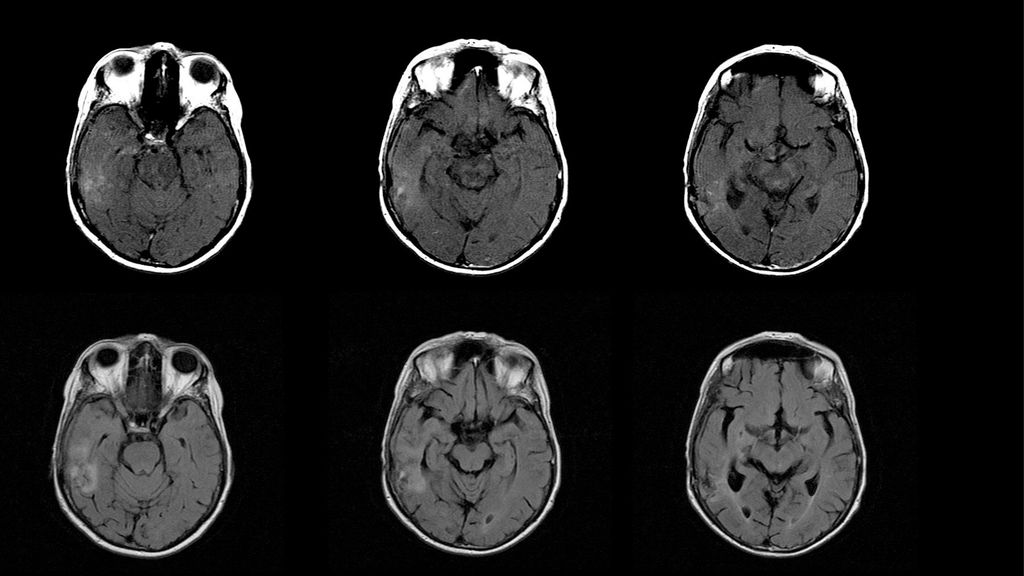 MELFI DIAZ DE HERRERA CC EDAD:68 AÑOS Postoperatorio resección glioma temporal. Antecedente de cirugía en fosa posterior para aislamiento de asa vascular