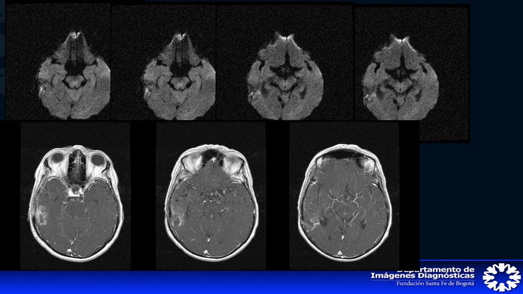 MELFI DIAZ DE HERRERA CC EDAD:68 AÑOS Postoperatorio resección glioma temporal. Antecedente de cirugía en fosa posterior para aislamiento de asa vascular