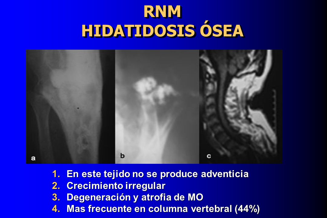 RNM HIDATIDOSIS ÓSEA En este tejido no se produce adventicia