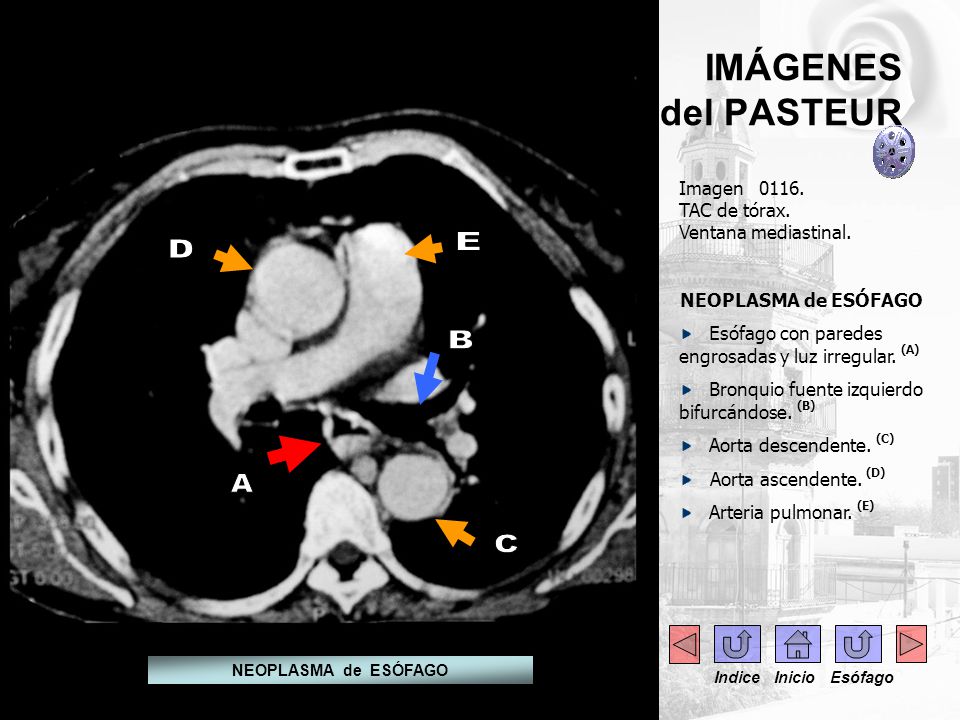E D B A C IMÁGENES del PASTEUR . Imagen TAC de tórax.