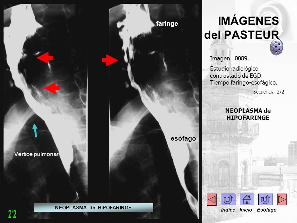 NEOPLASMA de HIPOFARINGE NEOPLASMA de HIPOFARINGE