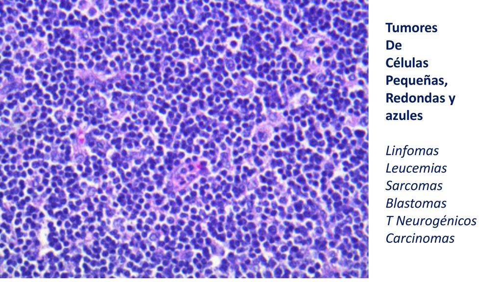Tumores De. Células. Pequeñas, Redondas y azules. Linfomas. Leucemias. Sarcomas. Blastomas. T Neurogénicos.