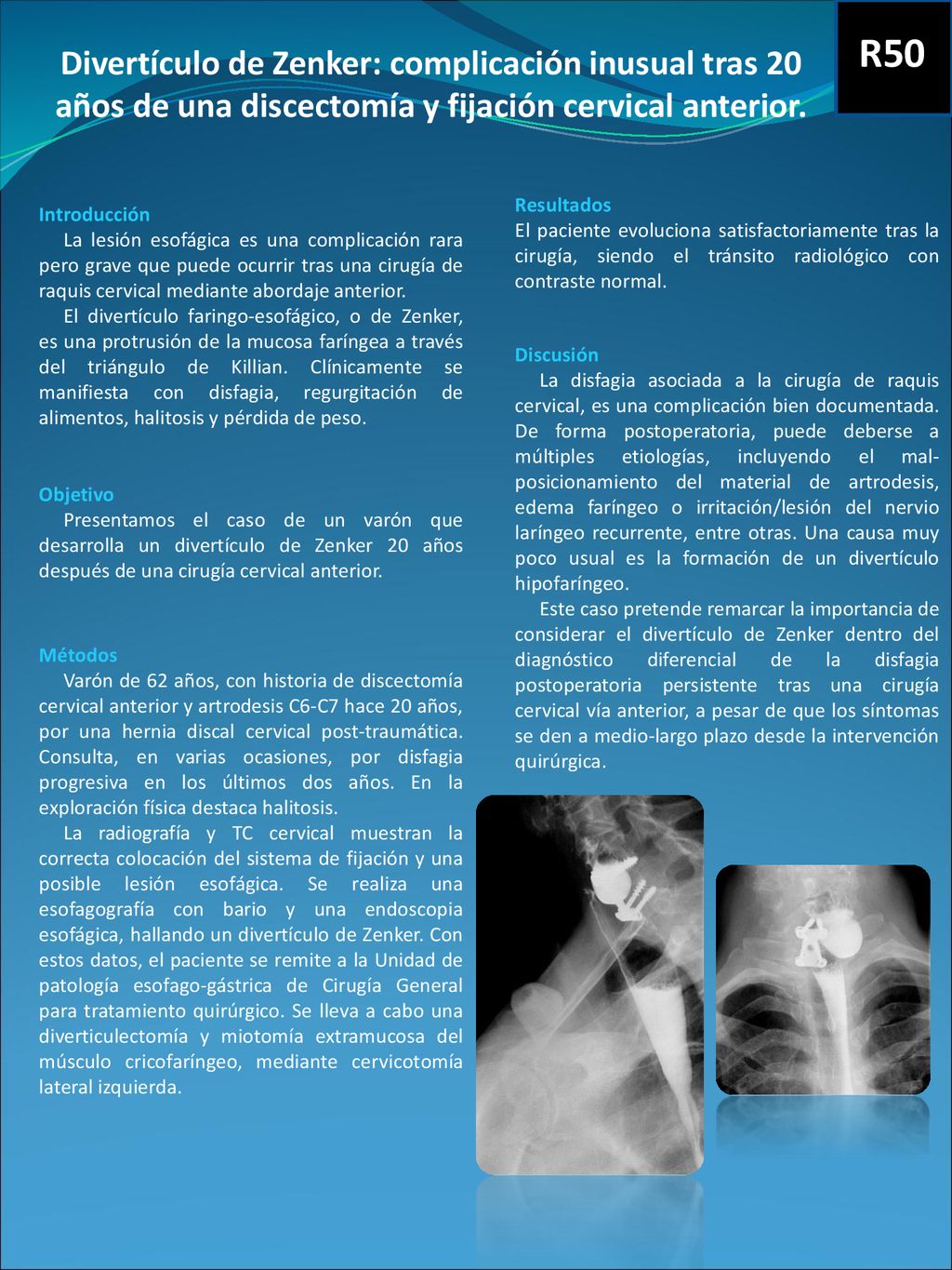 R50 Divertículo de Zenker: complicación inusual tras 20 años de una discectomía y fijación cervical anterior.
