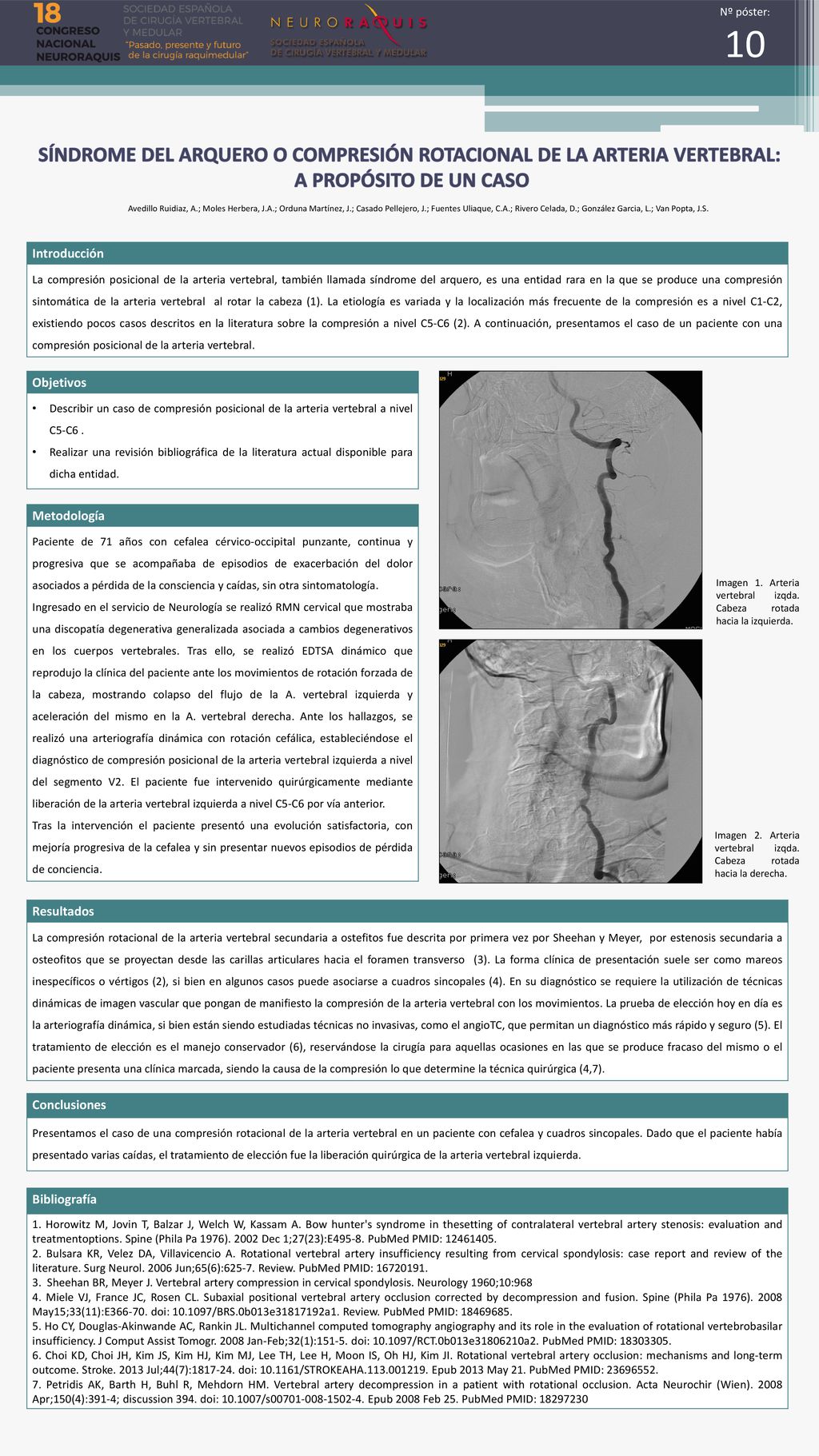 Nº póster: 10. SÍNDROME DEL ARQUERO O COMPRESIÓN ROTACIONAL DE LA ARTERIA VERTEBRAL: A PROPÓSITO DE UN CASO.
