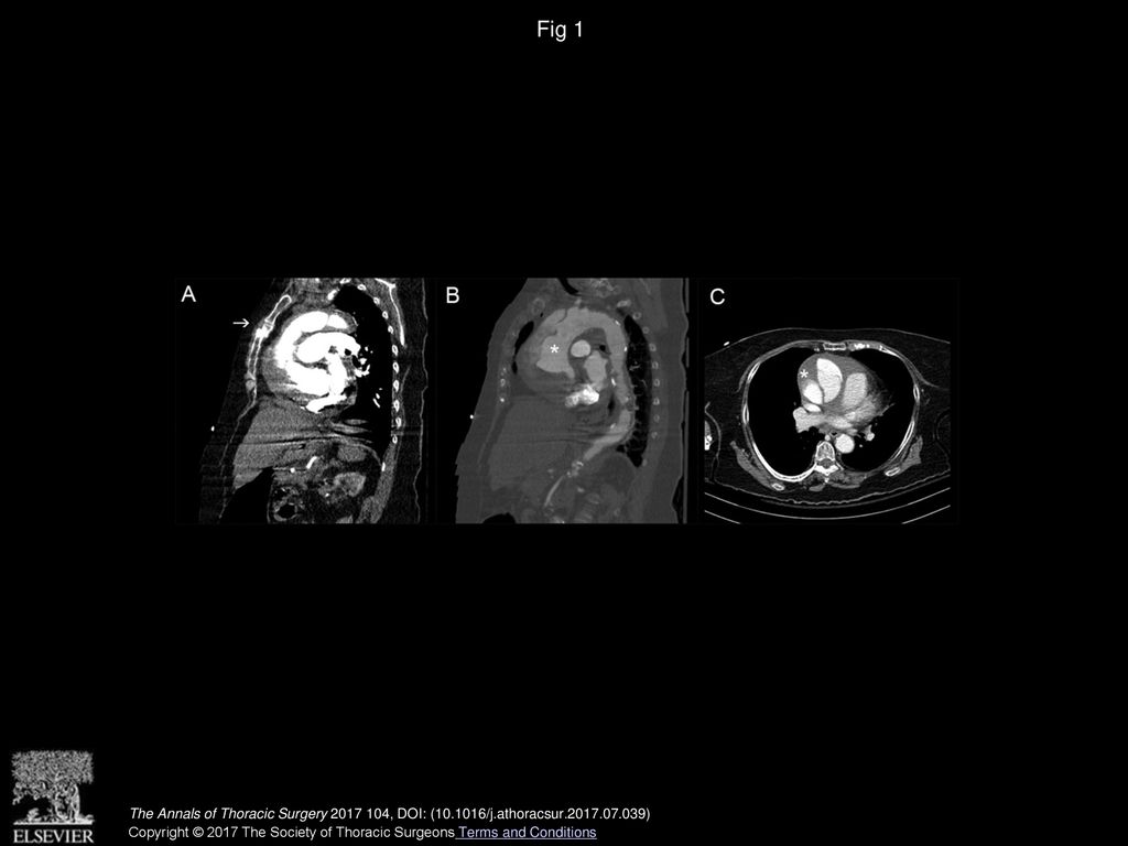 Fig 1 The Annals of Thoracic Surgery , DOI: ( /j.athoracsur )