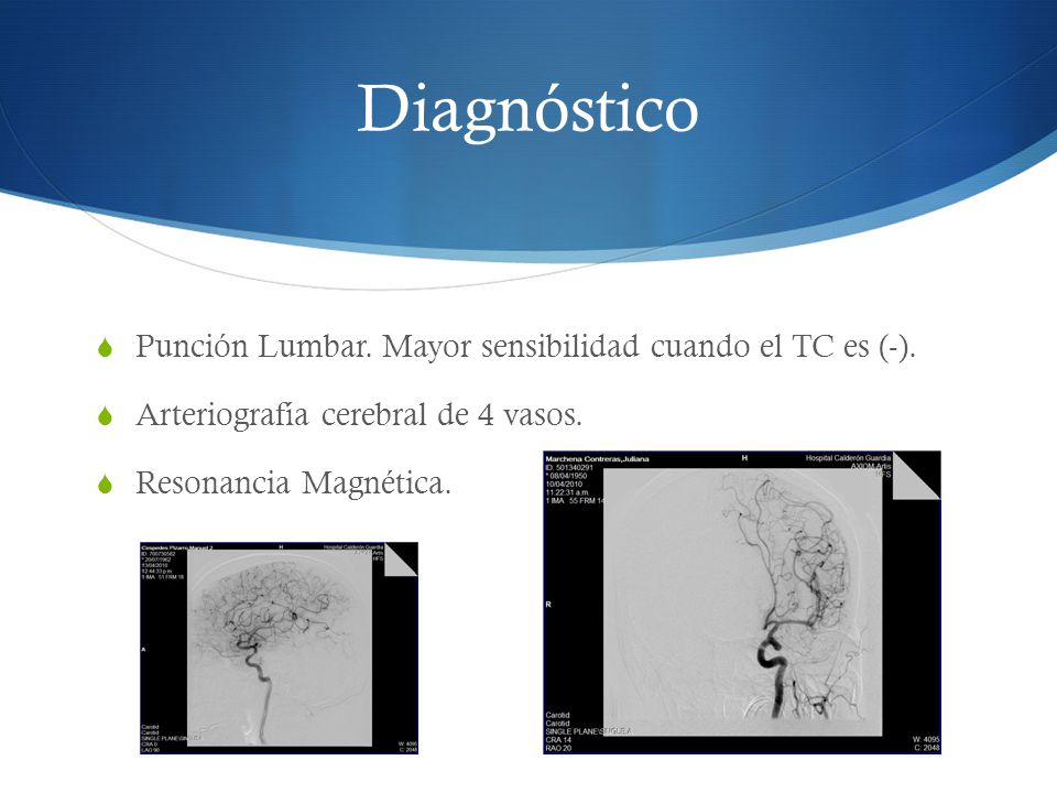 Diagnóstico Punción Lumbar. Mayor sensibilidad cuando el TC es (-).
