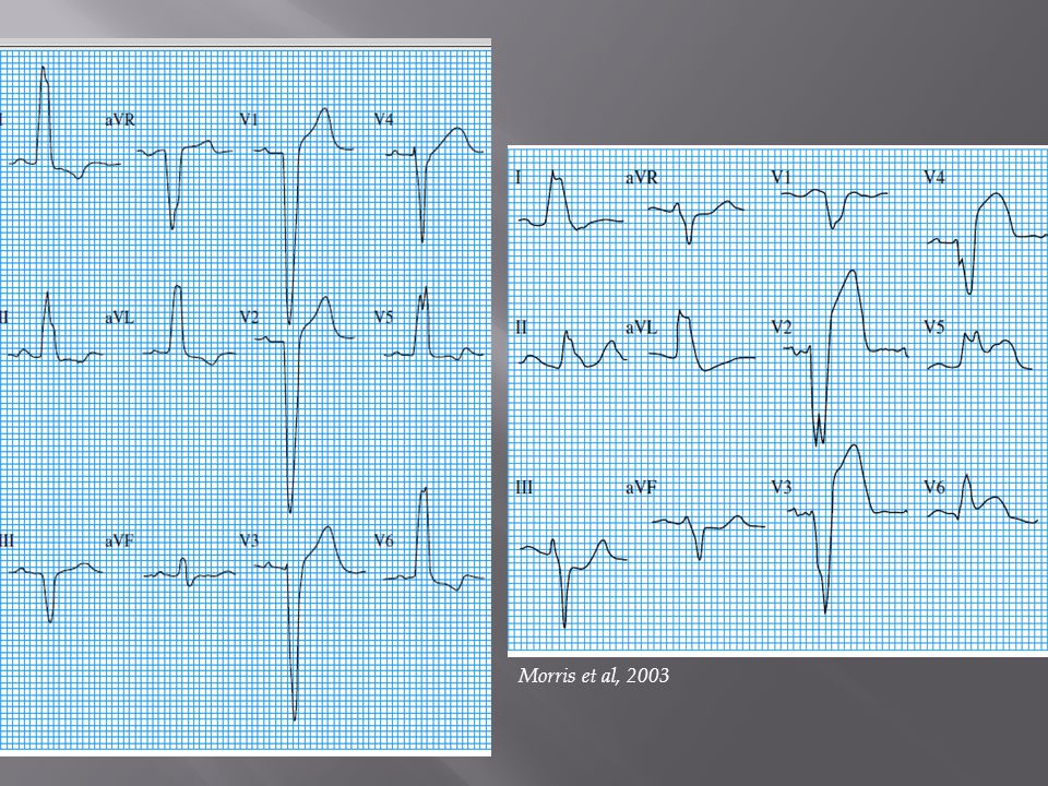 Appropriate discordance in uncomplicated left bundle branch block (note ST elevation in leads V1 to V3)