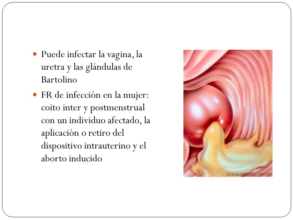 Puede infectar la vagina, la uretra y las glándulas de Bartolino