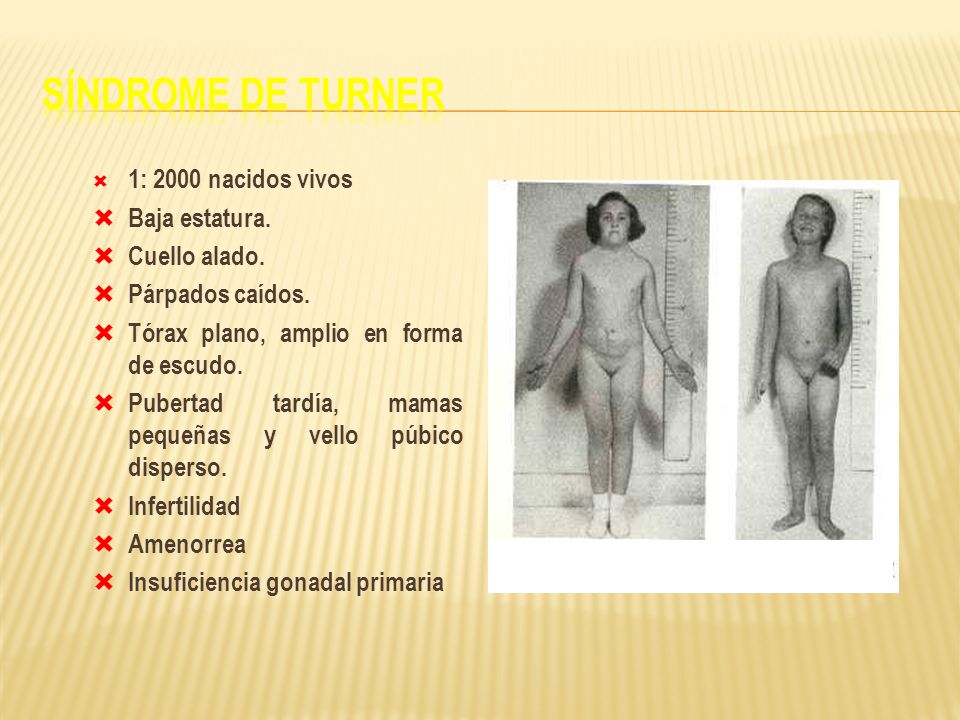 Síndrome de Turner 1: 2000 nacidos vivos Baja estatura. Cuello alado.