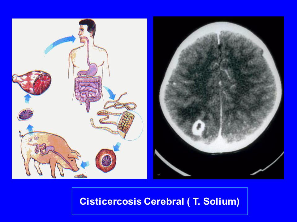 Cisticercosis Cerebral ( T. Solium)