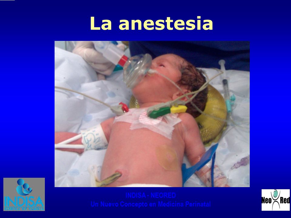 La anestesia