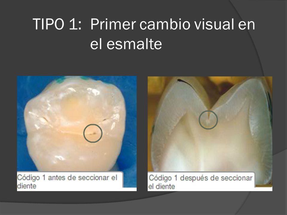TIPO 1: Primer cambio visual en el esmalte