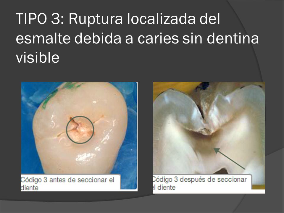 TIPO 3: Ruptura localizada del esmalte debida a caries sin dentina visible
