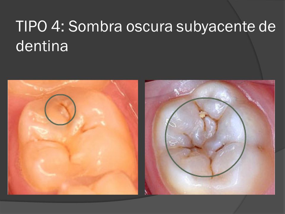 TIPO 4: Sombra oscura subyacente de dentina
