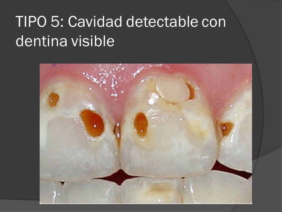 TIPO 5: Cavidad detectable con dentina visible