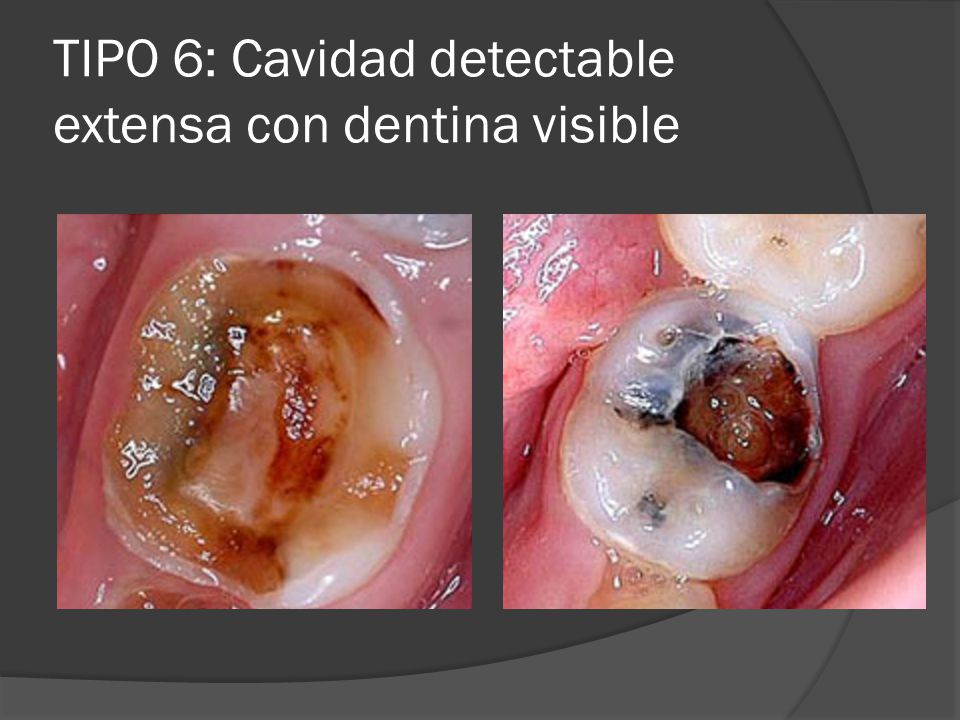 TIPO 6: Cavidad detectable extensa con dentina visible