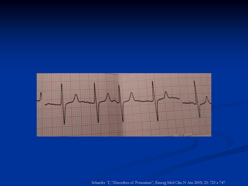 Schaefer T, Disorders of Potassium , Emerg Med Clin N Am 2005; 23: 723 a 747