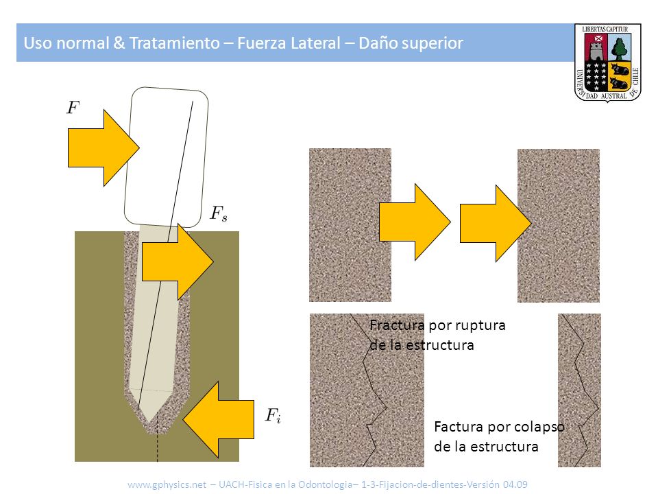 Uso normal & Tratamiento – Fuerza Lateral – Daño superior