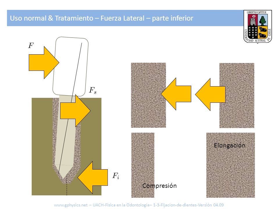 Uso normal & Tratamiento – Fuerza Lateral – parte inferior