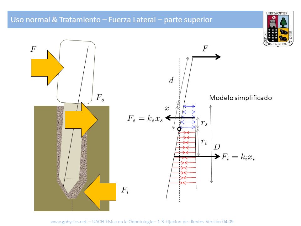 Uso normal & Tratamiento – Fuerza Lateral – parte superior