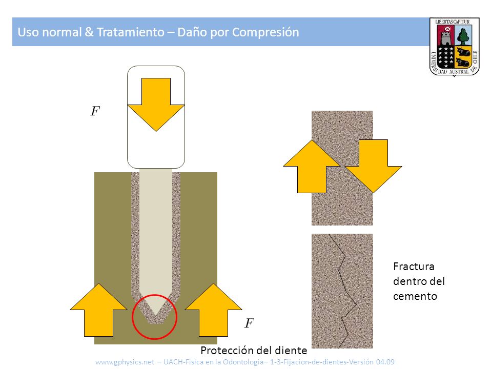 Uso normal & Tratamiento – Daño por Compresión