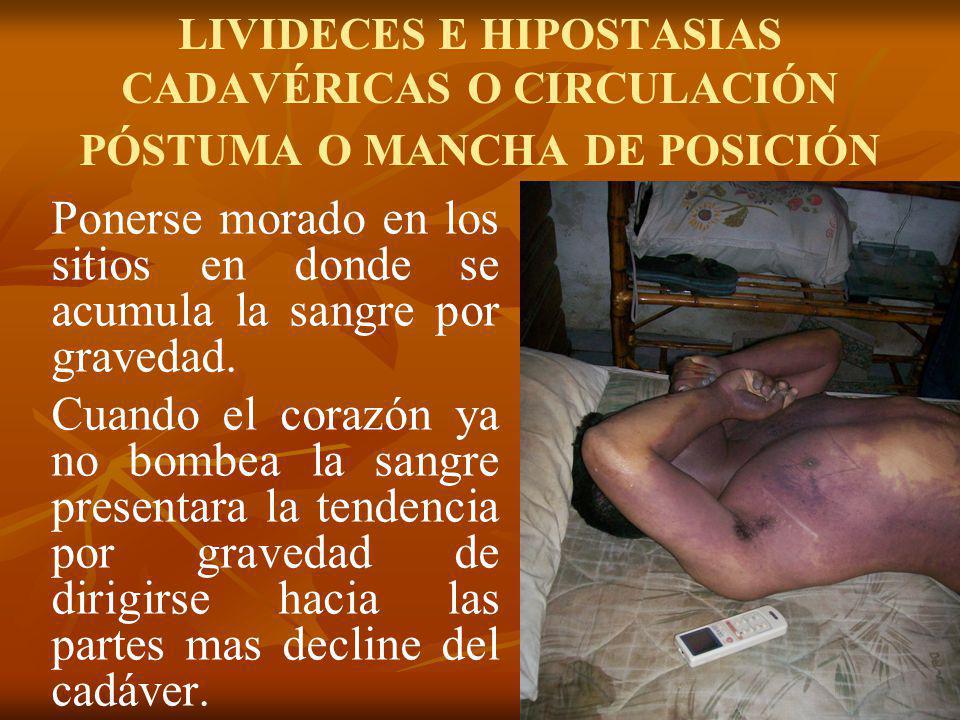 LIVIDECES E HIPOSTASIAS CADAVÉRICAS O CIRCULACIÓN PÓSTUMA O MANCHA DE POSICIÓN