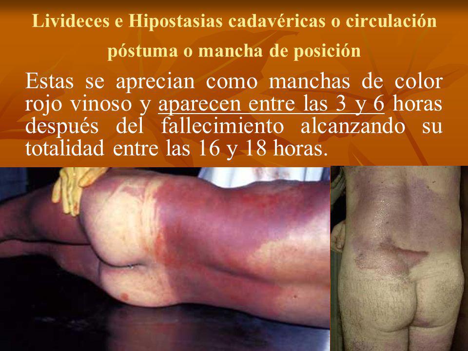 Livideces e Hipostasias cadavéricas o circulación póstuma o mancha de posición