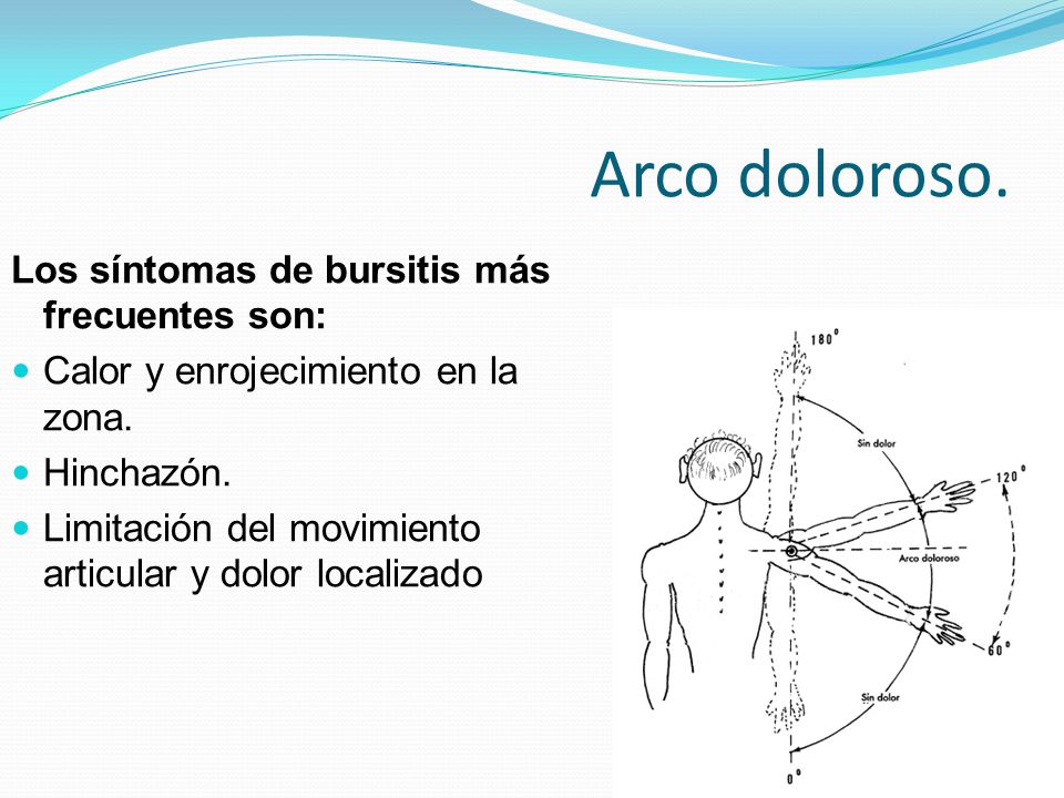 Arco doloroso. Los síntomas de bursitis más frecuentes son: