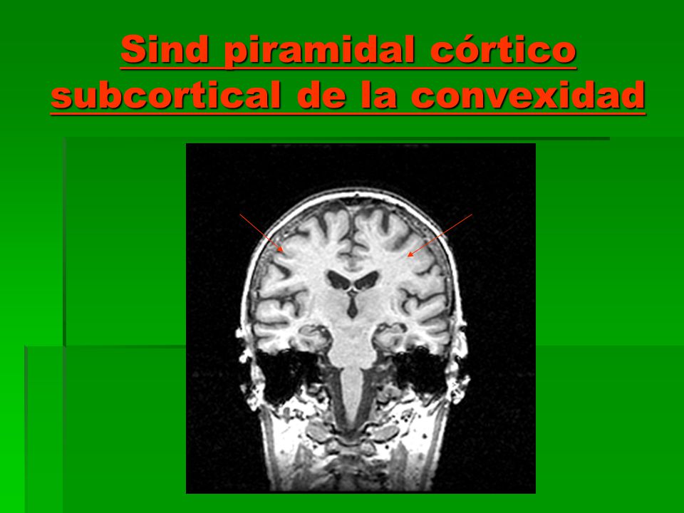 Sind piramidal córtico subcortical de la convexidad