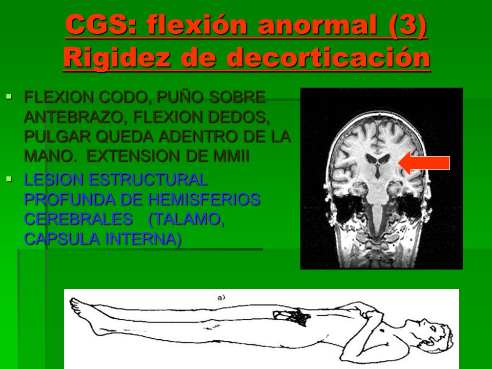 CGS: flexión anormal (3) Rigidez de decorticación
