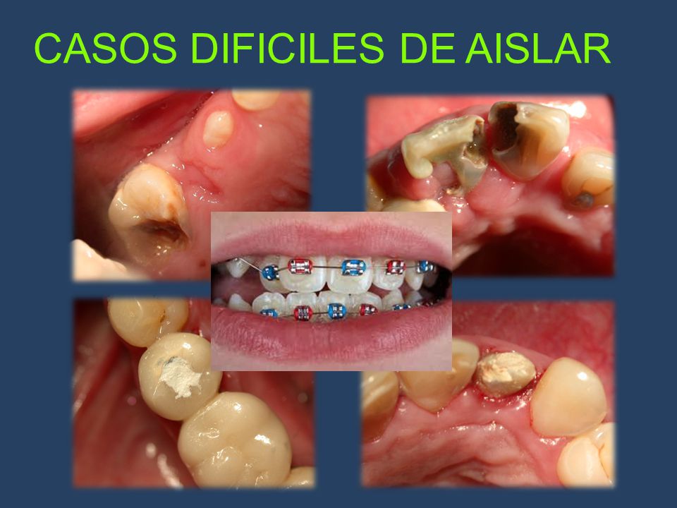 CASOS DIFICILES DE AISLAR
