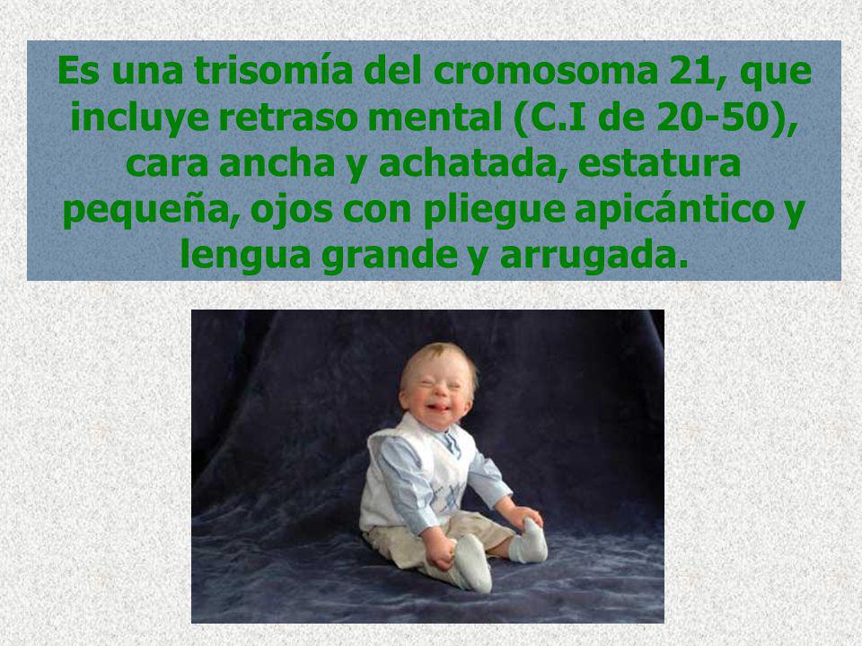 Es una trisomía del cromosoma 21, que incluye retraso mental (C