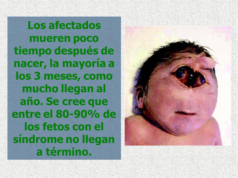 Los afectados mueren poco tiempo después de nacer, la mayoría a los 3 meses, como mucho llegan al año.