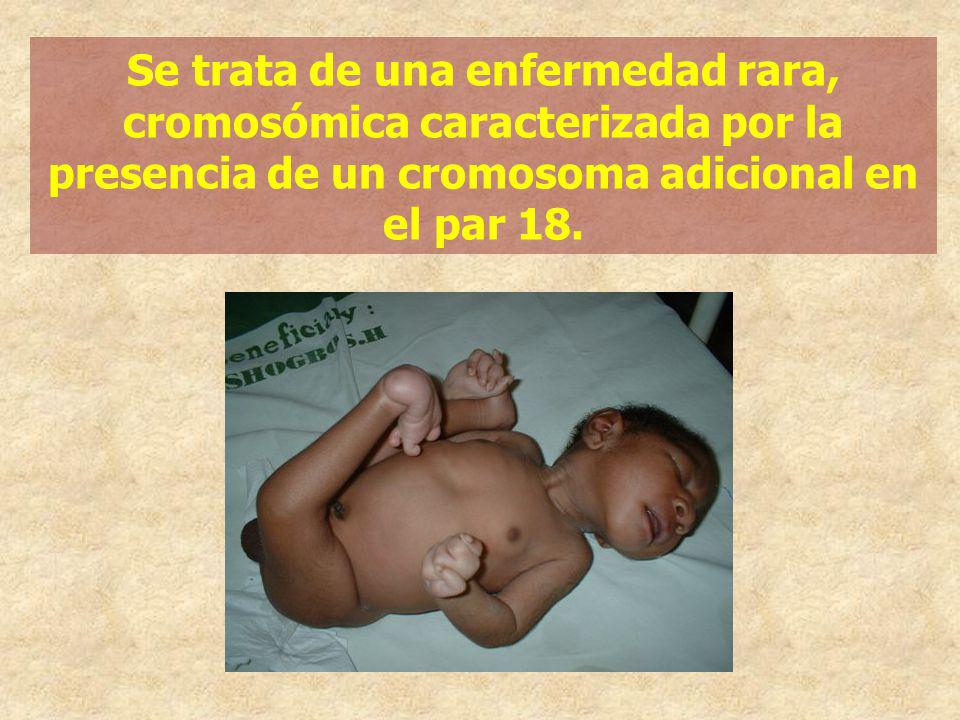 Se trata de una enfermedad rara, cromosómica caracterizada por la presencia de un cromosoma adicional en el par 18.