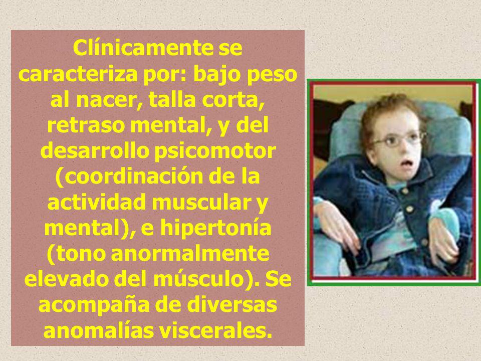 Clínicamente se caracteriza por: bajo peso al nacer, talla corta, retraso mental, y del desarrollo psicomotor (coordinación de la actividad muscular y mental), e hipertonía (tono anormalmente elevado del músculo).