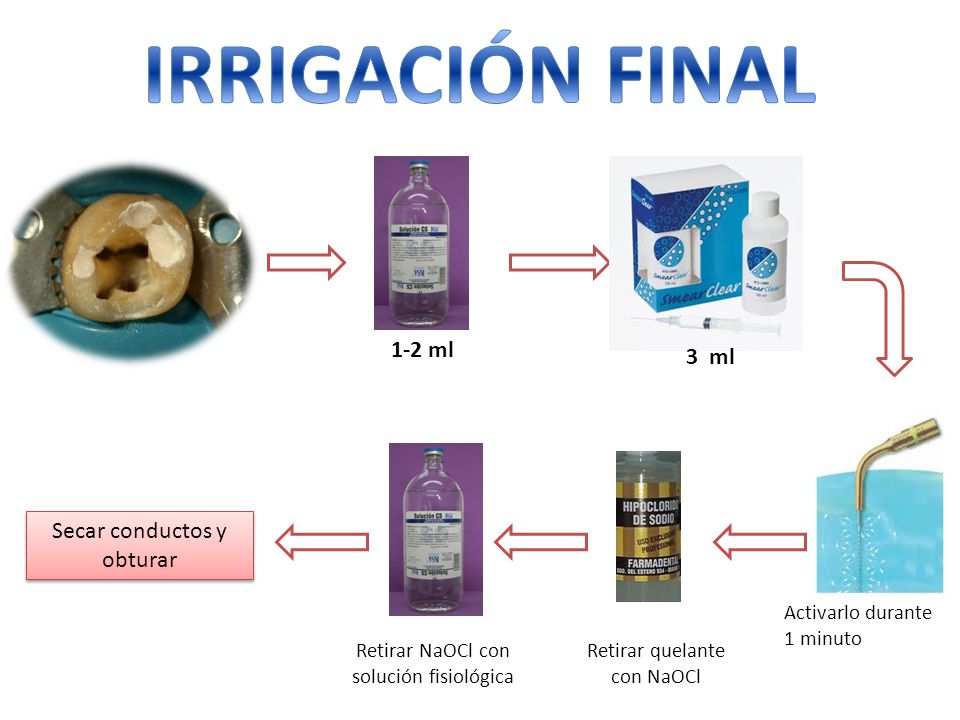 IRRIGACIÓN FINAL 1-2 ml 3 ml Secar conductos y obturar