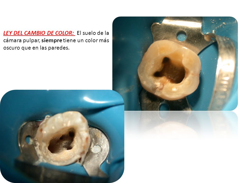 LEY DEL CAMBIO DE COLOR: El suelo de la cámara pulpar, siempre tiene un color más oscuro que en las paredes.