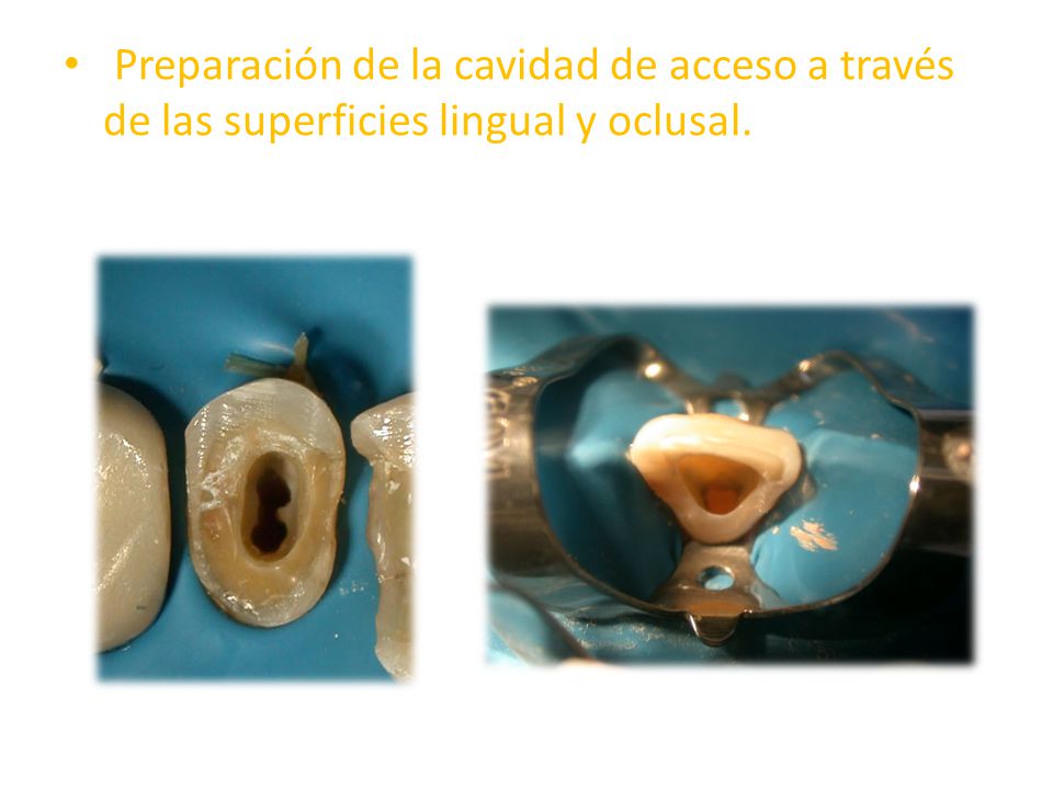 Preparación de la cavidad de acceso a través de las superficies lingual y oclusal.