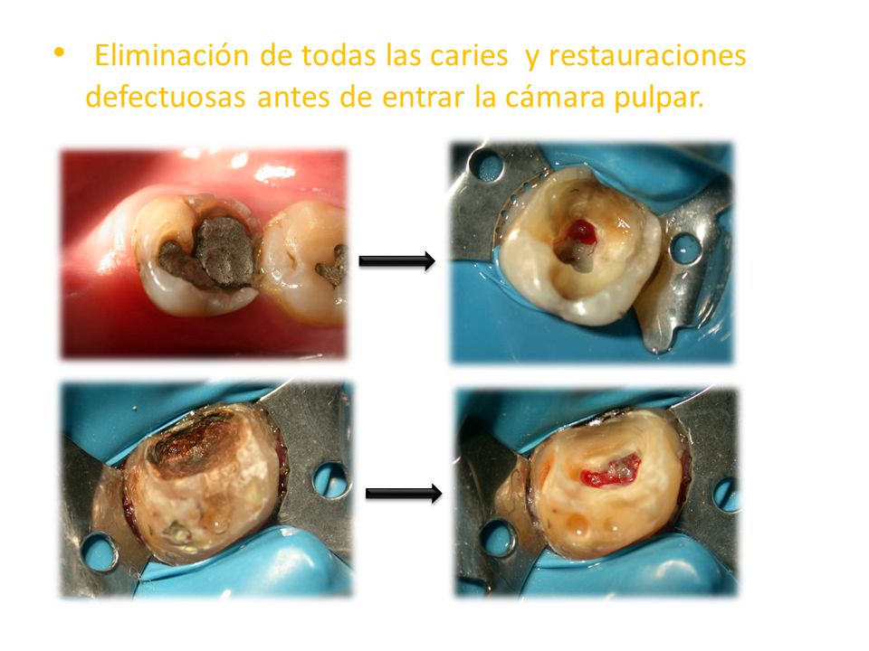 Eliminación de todas las caries y restauraciones defectuosas antes de entrar la cámara pulpar.