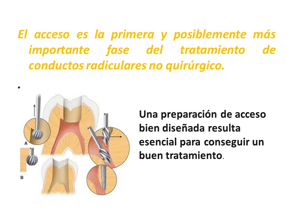 El acceso es la primera y posiblemente más importante fase del tratamiento de conductos radiculares no quirúrgico.