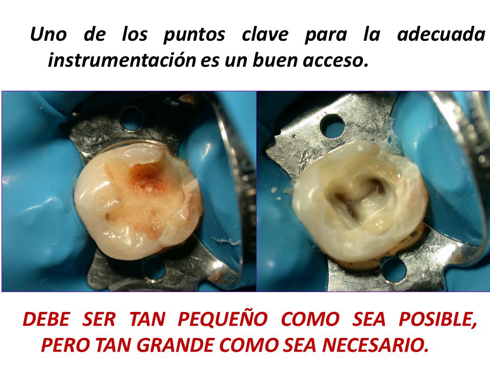 Uno de los puntos clave para la adecuada instrumentación es un buen acceso.