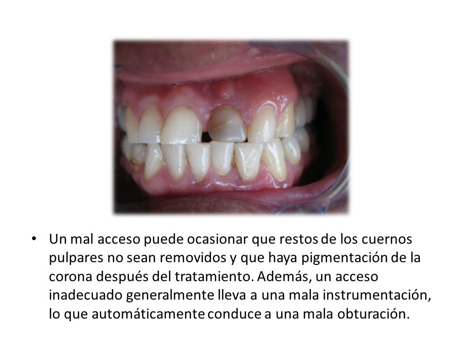 Un mal acceso puede ocasionar que restos de los cuernos pulpares no sean removidos y que haya pigmentación de la corona después del tratamiento.